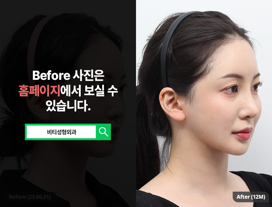 환자에게 딱 맞춘 안면윤곽 효과 관련 이미지 2