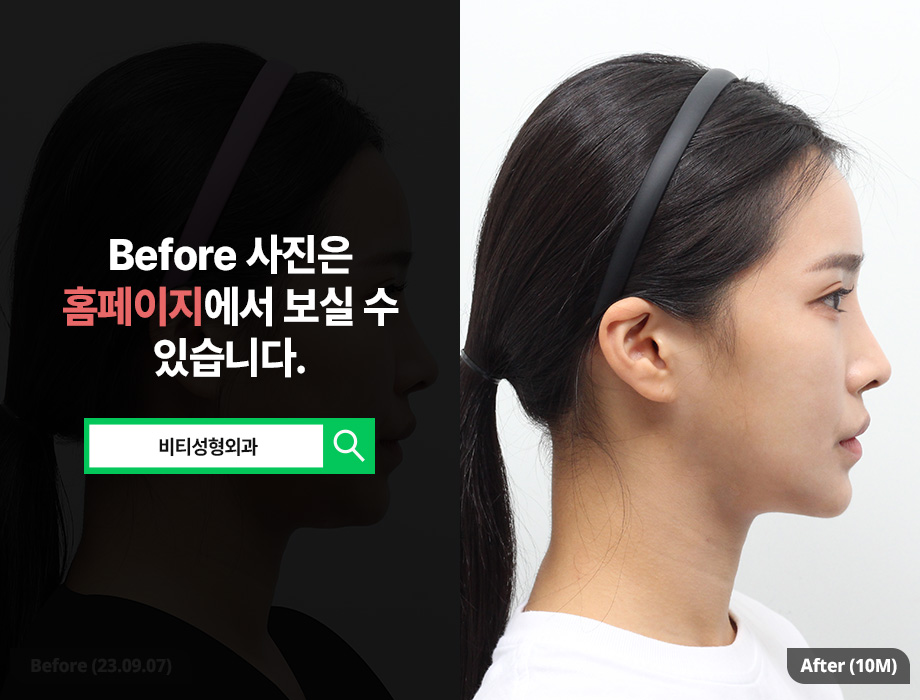 윤곽 수술 종류별 효과와 회복 기간까지 정리! 관련 이미지 3