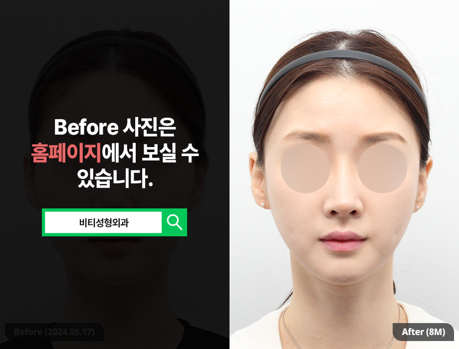 V-line Without T-Osteotomy? The Shocking Secret of Long-Curve Square Jaw Surgery image 1