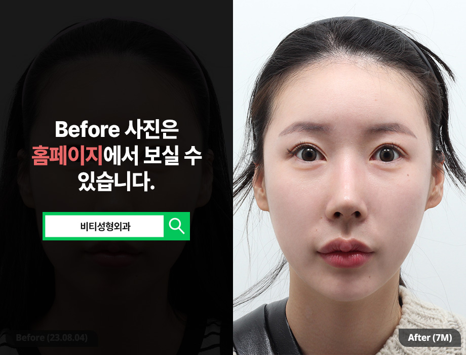 안면윤곽으로 입체감까지 챙기는 "무턱 교정" 관련 이미지 1