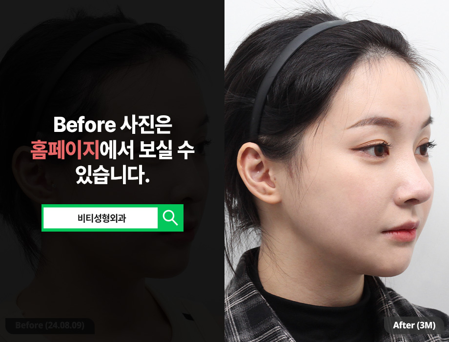 What Should You Check When Considering Facial Contouring Surgery? • A Real 3-Month Review of Contouring Surgery image 2