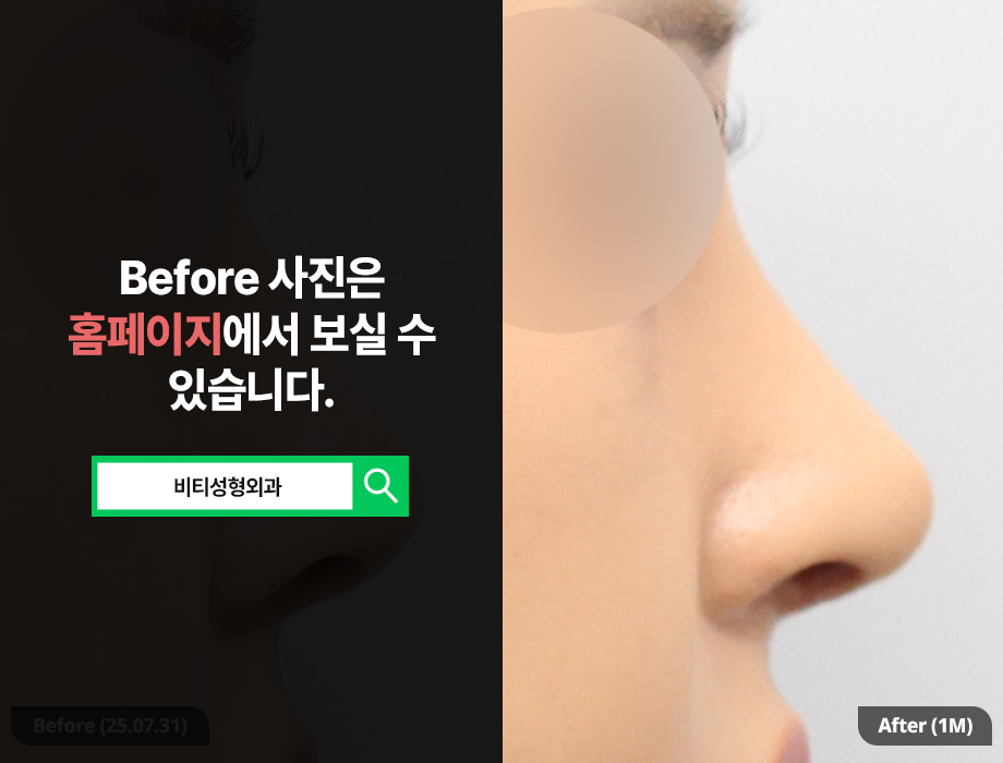 기증늑연골 코 재수술 솔루션 관련 이미지 1