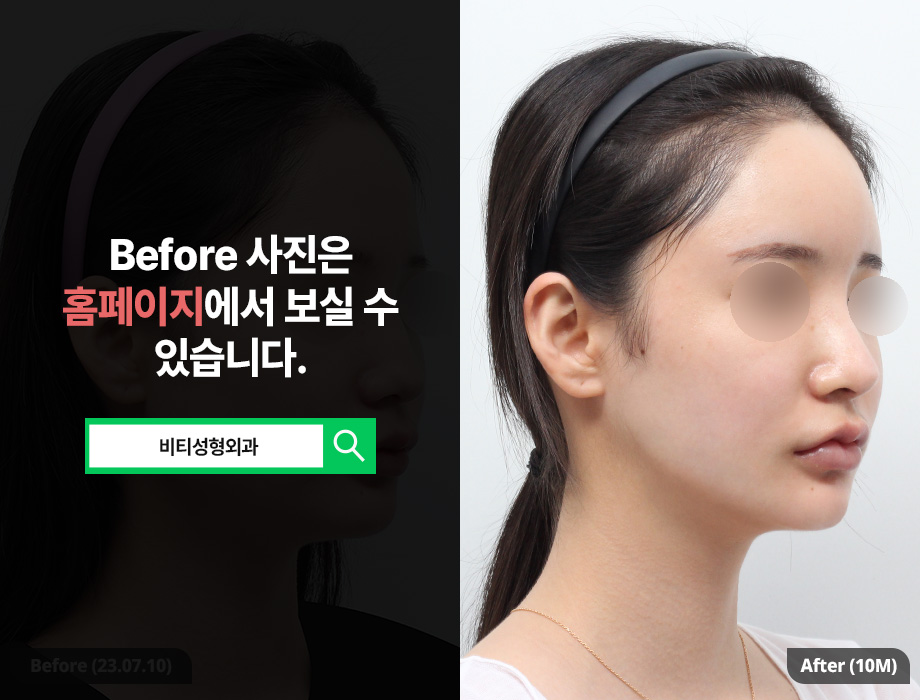 윤곽3종 수술 시 주의할 점 10개월 전후사진 관련 이미지 2