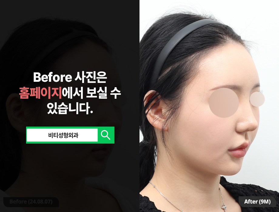 The Real 9-Month Update! Honest Review of BT Plastic Surgery Facial Contouring Type 1 + Face Liposuction image 2