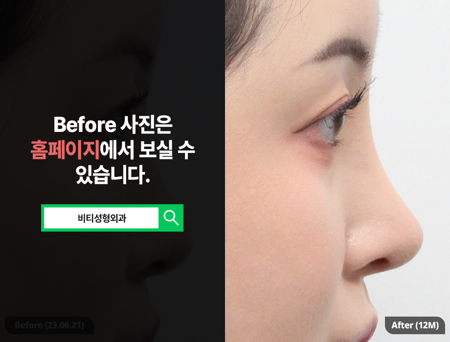 Bulbous Nose Rhinoplasty Is Not Solved by Simply Making It Higher image 1