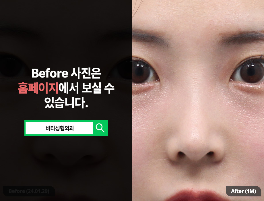 매부리코 복코 필러로는 안되는 이유! 관련 이미지 3