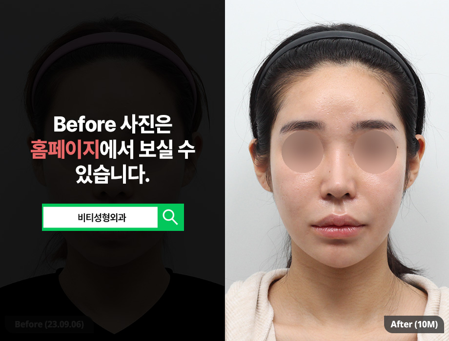 윤곽 3종 수술, 왜 한 번에 받는 걸까? 관련 이미지 1