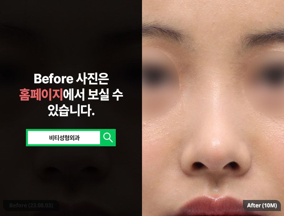 4 Reasons Why It’s Good to Bring Celebrity Photos Before Rhinoplasty image 3
