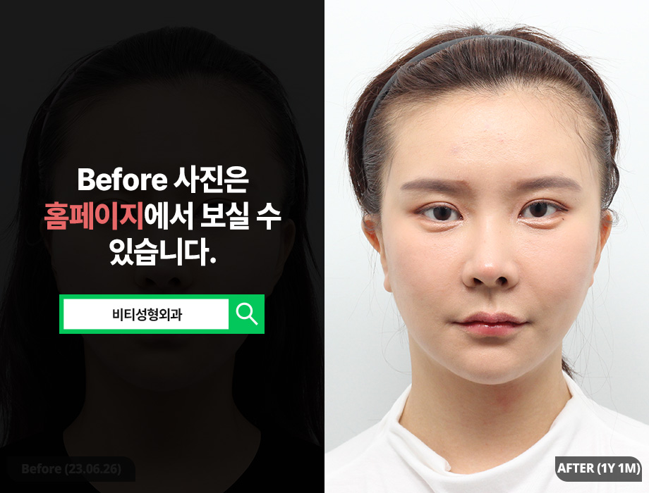 A Real Review 1 Year After Surgery for Minimizing Cheekbone Reduction Side Effects image 1