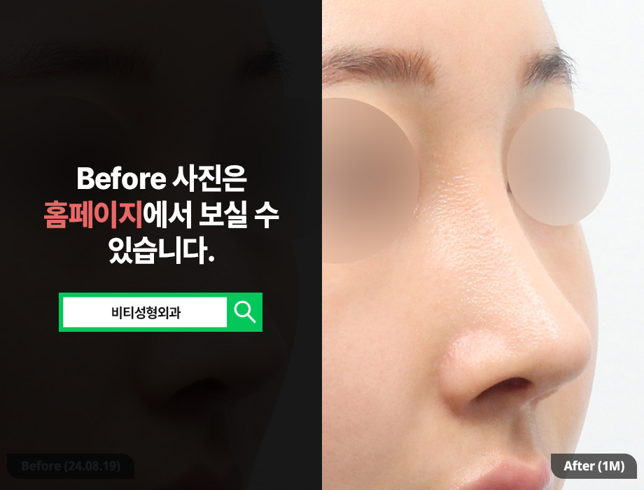 코 재수술, 기증늑연골로 긴코 교정한 케이스? 관련 이미지 2