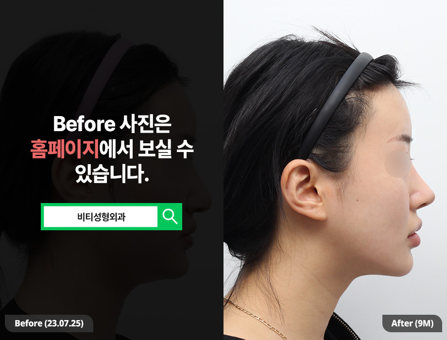 얼굴 지흡까지 해야 갸름해지는 이유, 9개월 변화로 증명 관련 이미지 3