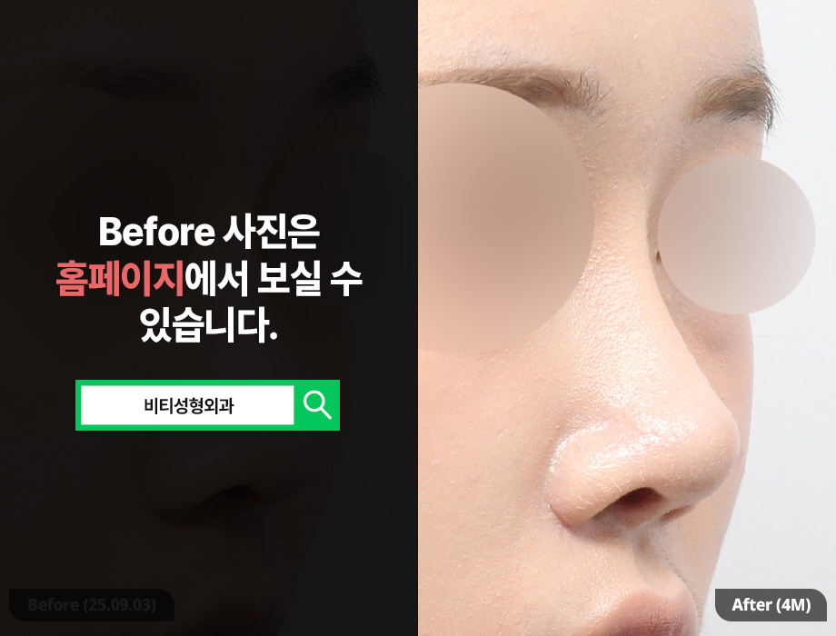 코재수술, 실패 원인 분석부터 재료까지 | 4개월차 성공 사례 관련 이미지 2