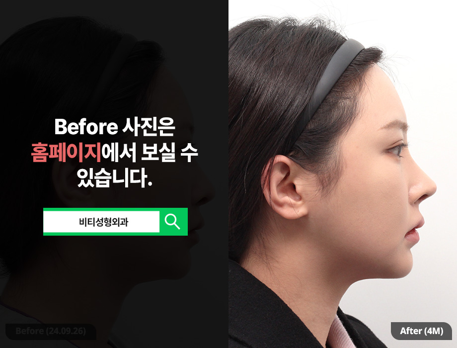 윤곽3종 + 이중턱 지방흡입 4개월 진짜후기!! 관련 이미지 3