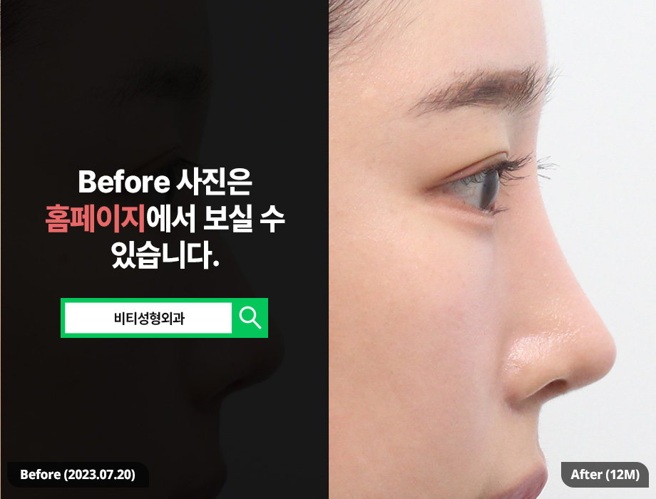 When Is the Most Appropriate Time for Revision Nose Surgery for a Pinched Nose? image 1
