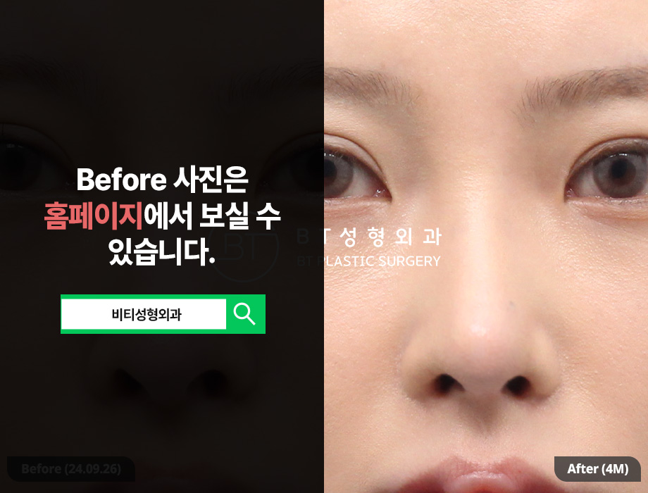 코재수술, 기능과 디자인 한번에! 기능미용코 4개월 찐후기 관련 이미지 3