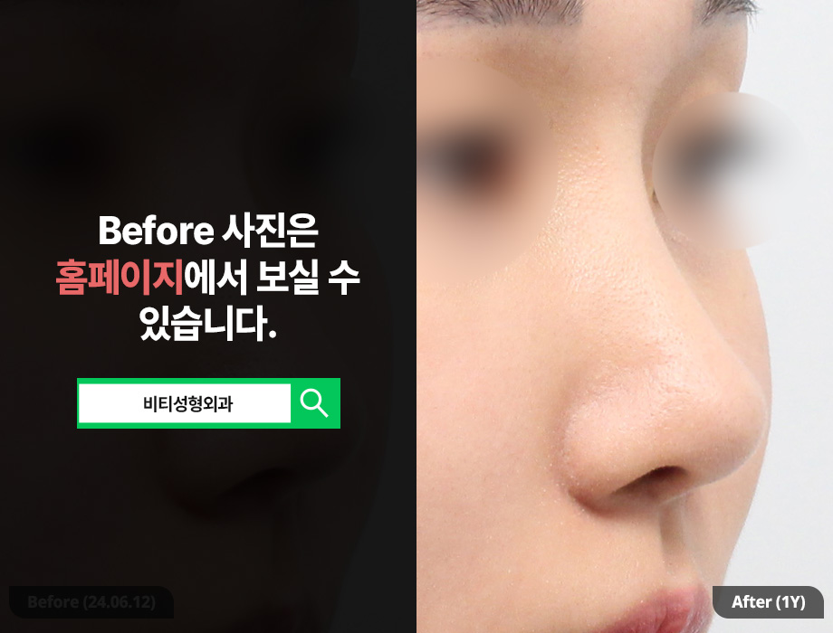 귀연골로 복코 교정 가능한가요? + 코 필러 제거 관련 이미지 2