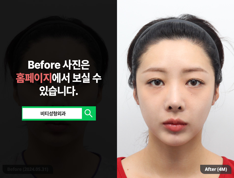 살을 빼도 턱살이 안빠져요 이중턱 근육묶기로 관련 이미지 1