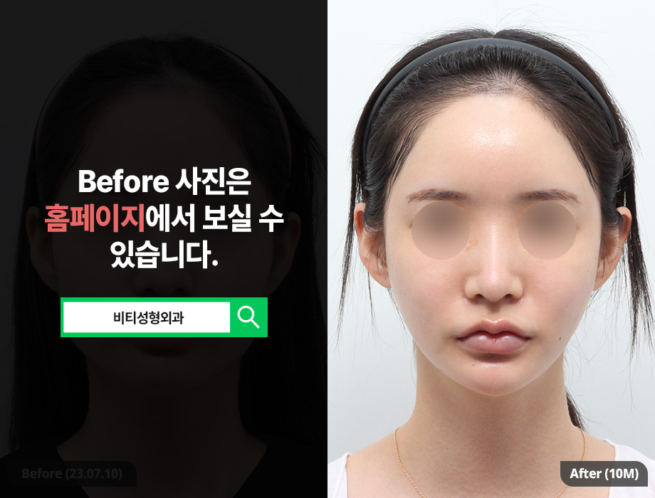윤곽3종 수술 시 주의할 점 10개월 전후사진 관련 이미지 1