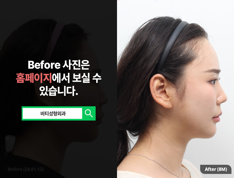 3-Part Facial Contouring, 8-Month Real Review After Long-Curved Square Jaw Surgery! image 3