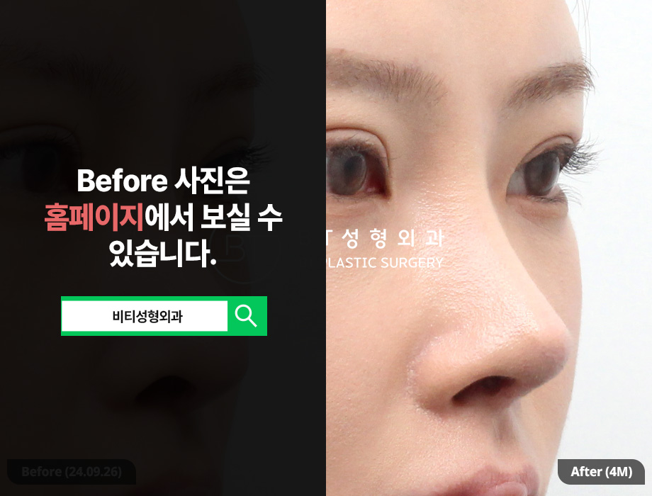 코재수술, 기능과 디자인 한번에! 기능미용코 4개월 찐후기 관련 이미지 2