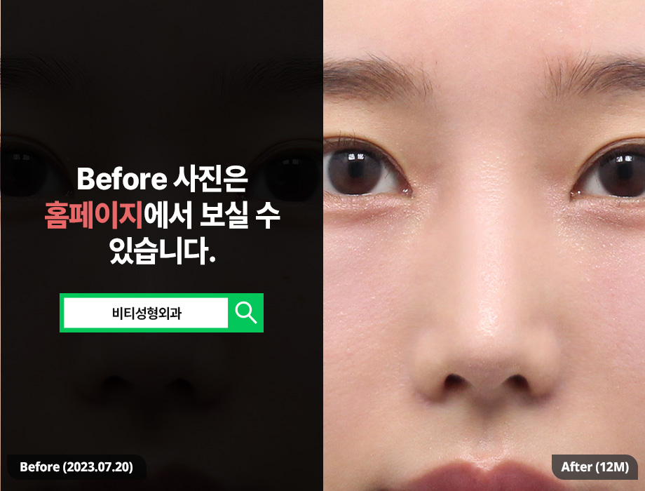 When Is the Most Appropriate Time for Revision Nose Surgery for a Pinched Nose? image 3