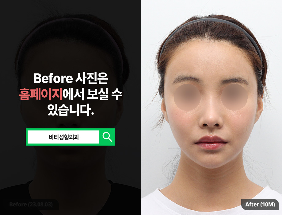 추구미에 딱 맞는 윤곽성형✨ 비티 퍼스널 안면윤곽 관련 이미지 1