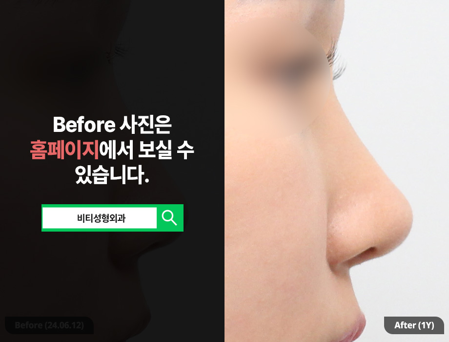 귀연골로 복코 교정 가능한가요? + 코 필러 제거 관련 이미지 1