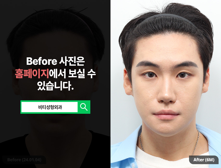 남자 윤곽수술, 여자랑 똑같이 하면 안되는 이유 관련 이미지 1