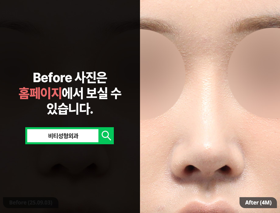 코재수술, 실패 원인 분석부터 재료까지 | 4개월차 성공 사례 관련 이미지 3