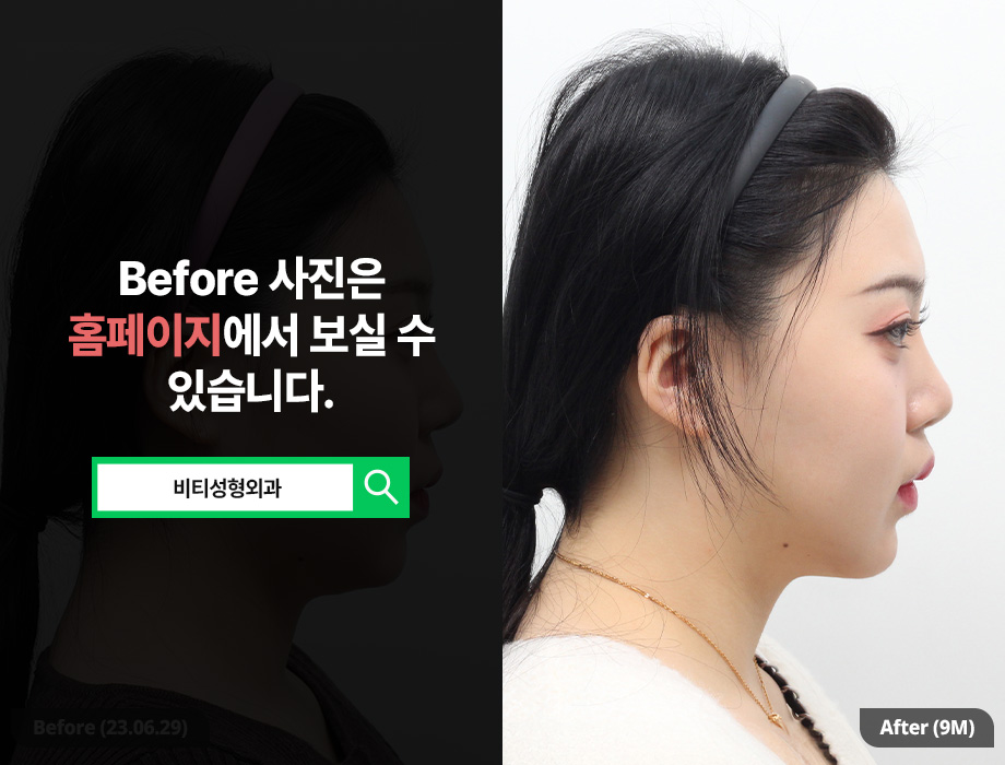 윤곽 3종 수술 효과 극대화하는 법 궁금하다 관련 이미지 3