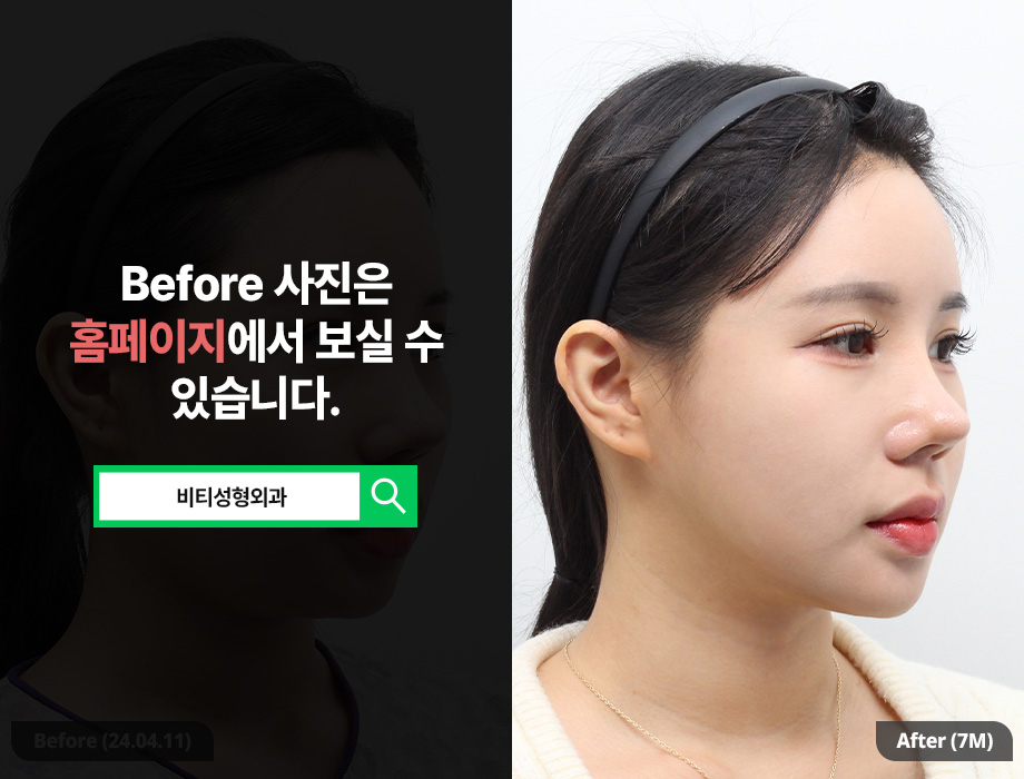 윤곽3종, 살 빼고 수술해야 더 예쁜 라인 나오는 이유 관련 이미지 2