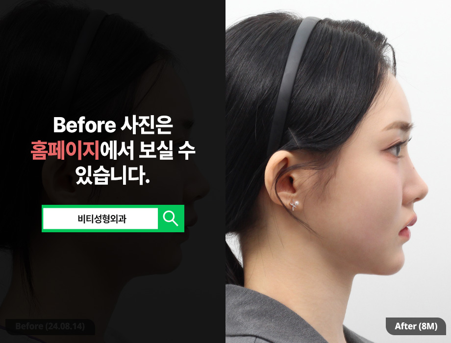 [비티성형외과] 자려한 윤곽 3종 | 자연스러우면서 화려한 V라인, 8개월 찐후기 관련 이미지 3