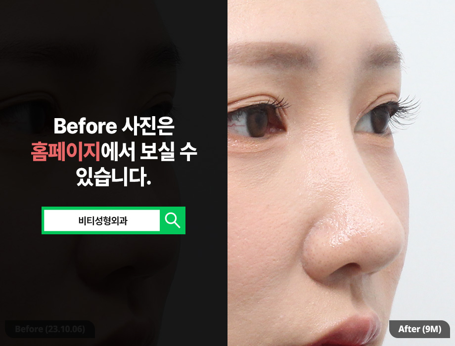 True Satisfaction Comes Only When You Achieve Both Function and Aesthetics in Nose Surgery! image 2