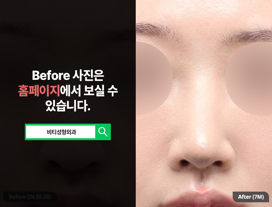 Non-implant Rhinoplasty, Novo Nose Surgery (Hump Nose + Bulbous Nose) 7-Month Real Review image 3