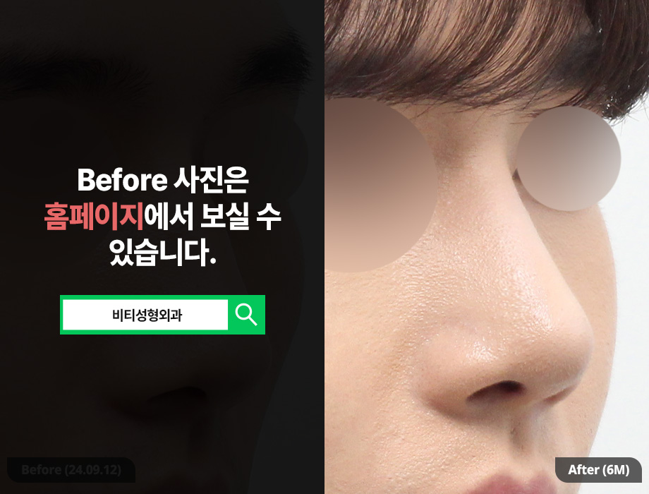 [남자 코성형] 무보형물 코성형이 뜨는이유? 관련 이미지 2