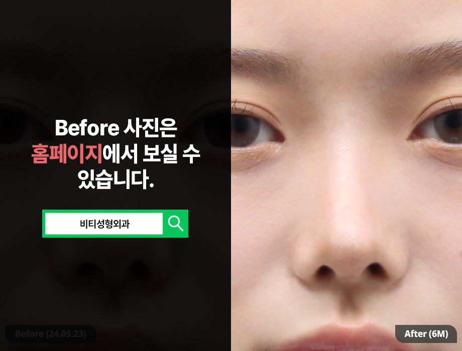 한국에서 코 재수술, 일본인도 찾는 이유? 관련 이미지 3