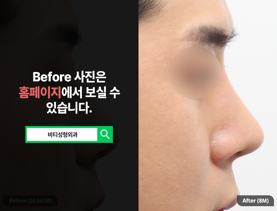 남자코 고민이라면? 매부리부터 실제거까지 한 번에 관련 이미지 1