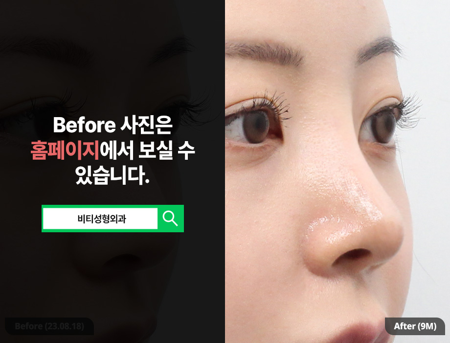 If You Want to Transform a Hump Nose and Bulbous Nose into a Glamorous Nose! image 2