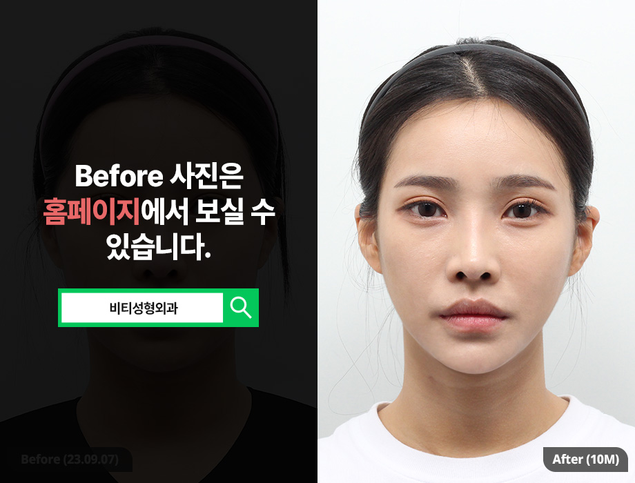 윤곽 수술 종류별 효과와 회복 기간까지 정리! 관련 이미지 1