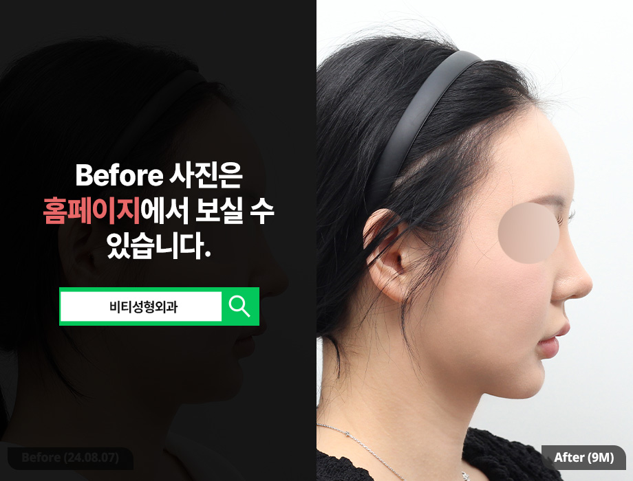 The Real 9-Month Update! Honest Review of BT Plastic Surgery Facial Contouring Type 1 + Face Liposuction image 3