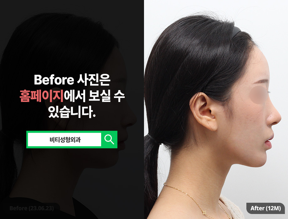 전후차이 확실한 안면윤곽 고려하고 있다면 관련 이미지 3