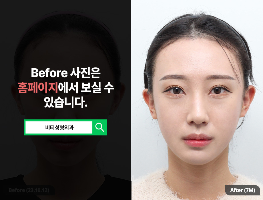 무턱+비대칭 얼굴형, 윤곽 3종으로 개선 가능할까? 관련 이미지 1