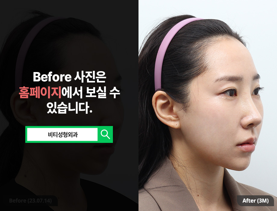 윤곽수술+얼굴지방흡입 동시 진행으로 효과 2배!! 관련 이미지 2