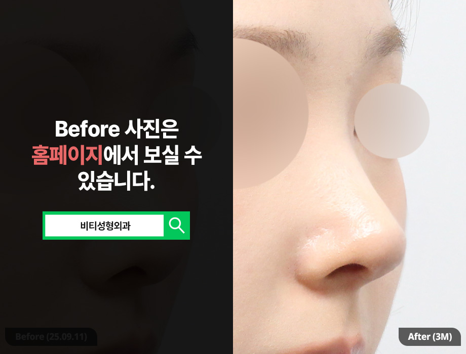무보형물 코성형 노보코 3개월 후기🔥 매부리·복코·비순각까지 한번에 관련 이미지 2