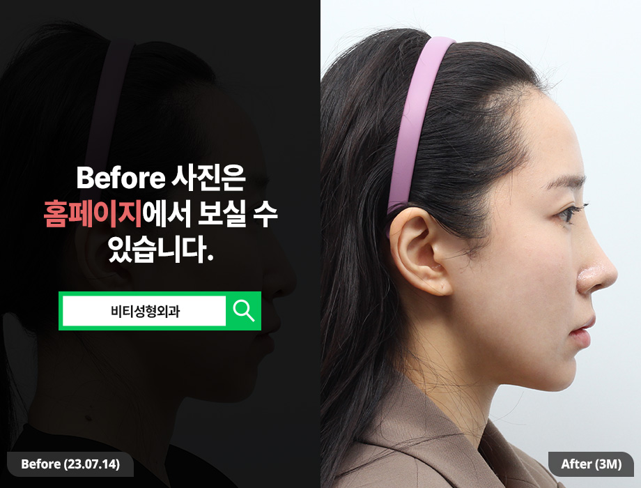 윤곽수술+얼굴지방흡입 동시 진행으로 효과 2배!! 관련 이미지 3