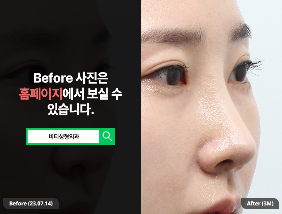 To Get Insurance Benefits and Cosmetic Nose Surgery Done at Once: Functional Aesthetic Rhinoplasty image 2