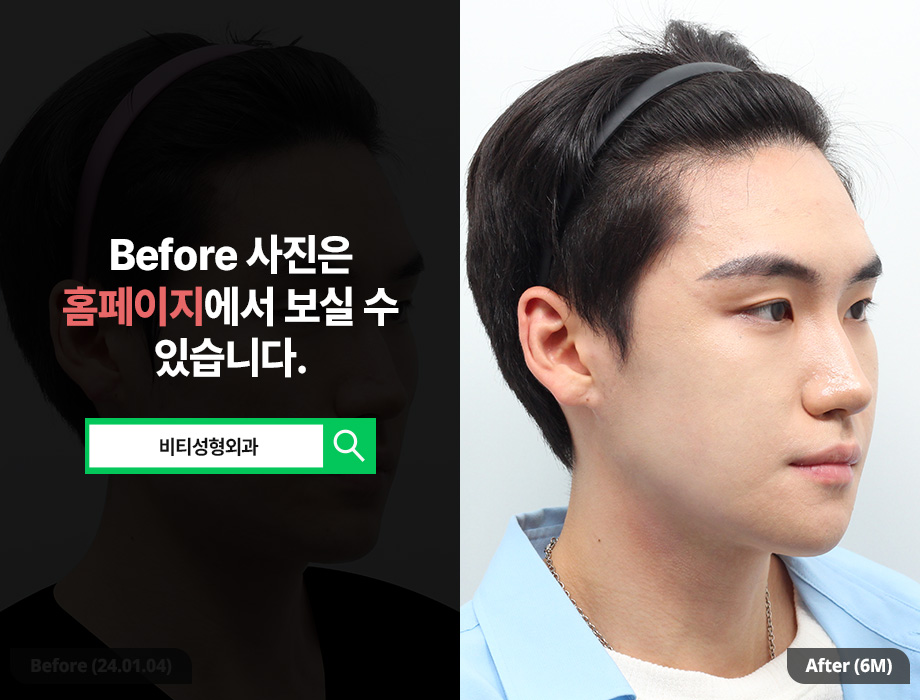 남자 윤곽수술, 여자랑 똑같이 하면 안되는 이유 관련 이미지 2