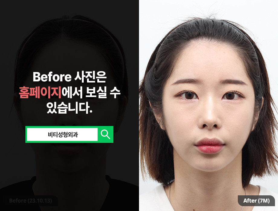 Cheekbone + Square Jaw + Receding Chin Surgery: A Facial Contouring Combination That Balances Face Shape image 1