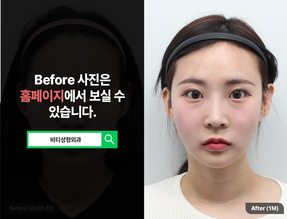 윤곽3종 + 얼굴지방흡입, 요즘 트렌드는? 1개월 리얼후기 관련 이미지 1