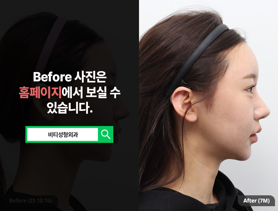 Why Choose Contouring Surgery Instead of Filler? The Differences and Effects of the 3 Procedures image 3